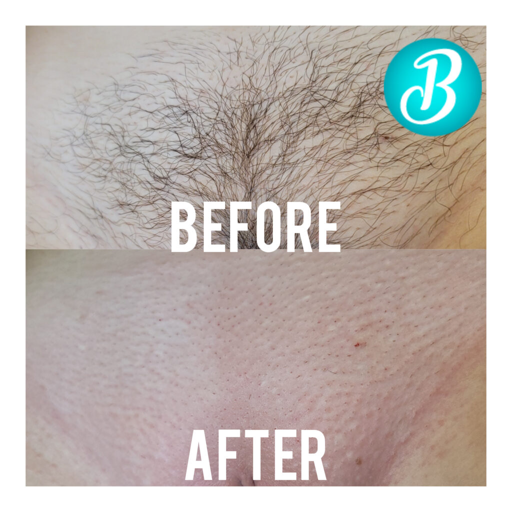 Brazilian wax before and after look Brazilian Wax Studio